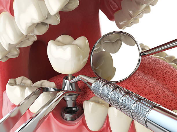 Best Broken or Cracked Tooth Emergency Dentist in Healdsburg, CA